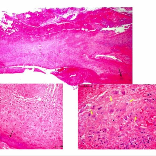 139 – Atualizações no Manejo da Endocardite Infecciosa