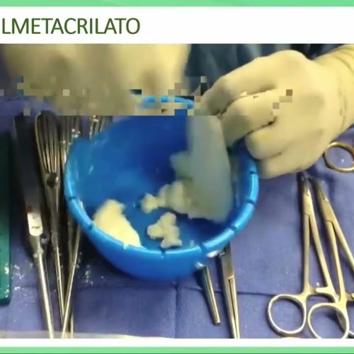 66 – Antimicrobianos de Uso Tópico nas infecções Musculoesqueléticas