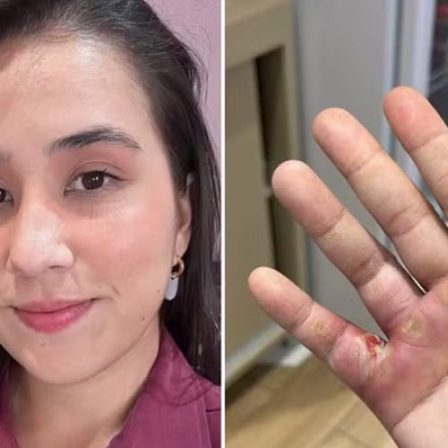 Marie Claire Saúde – ‘Quase perdi o dedo da mão por causa do CrossFit, após uma bolha infeccionar’ – Leia aqui: