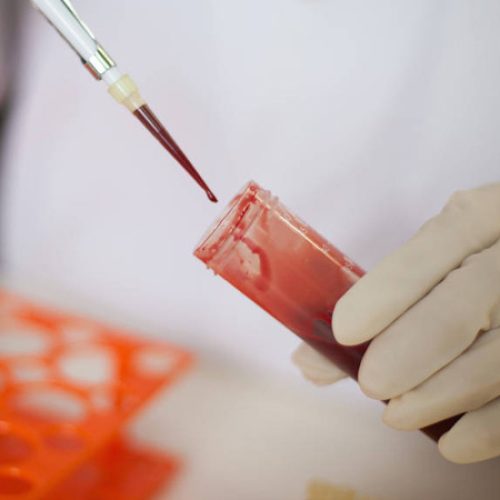 Folha de S. Paulo – Mesmo que vídeo de ‘carimbador’ infectando papel com HIV fosse real, transmissão seria difícil – Leia aqui: