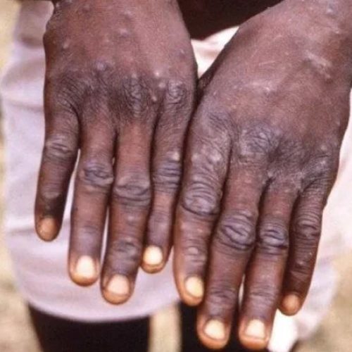 Correio Braziliense – Casos de mpox disparam em 160% na África e OMS decreta emergência global – Leia aqui: