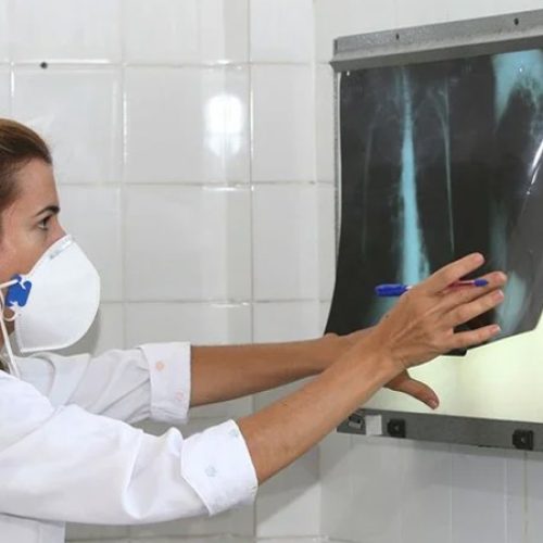 Vida & Ação – Resistência a medicamentos para controle da tuberculose preocupa. Leia aqui:
